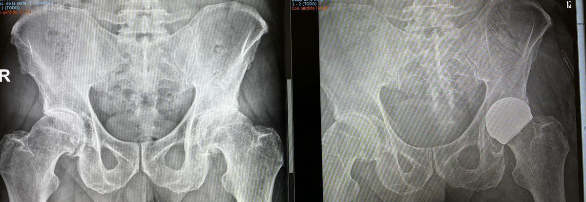 La robótica proporciona una planificación mucho más precisa y ayuda a posicionar los implantes con una exactitud milimétrica durante la cirugía.