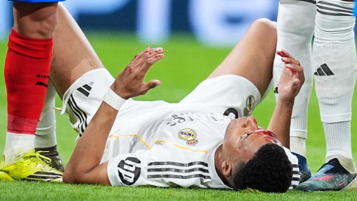 Mbappé en el suelo con sangre en la cara