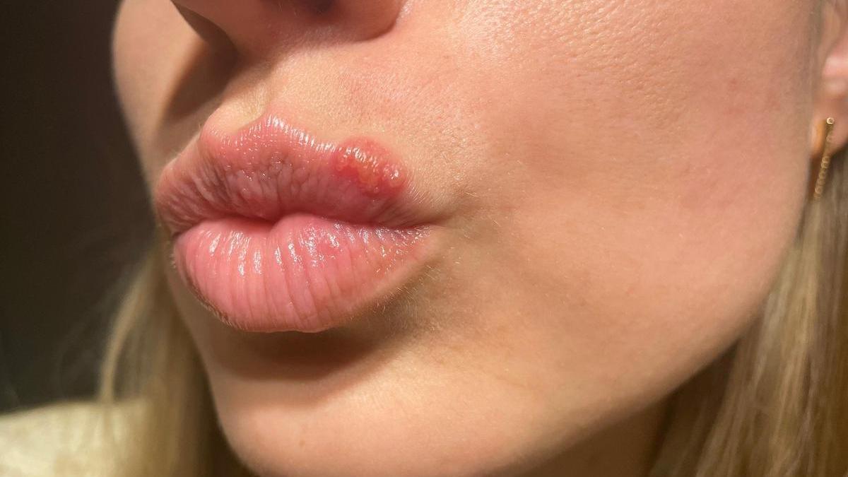 Calentura labial: cómo acabar con ella