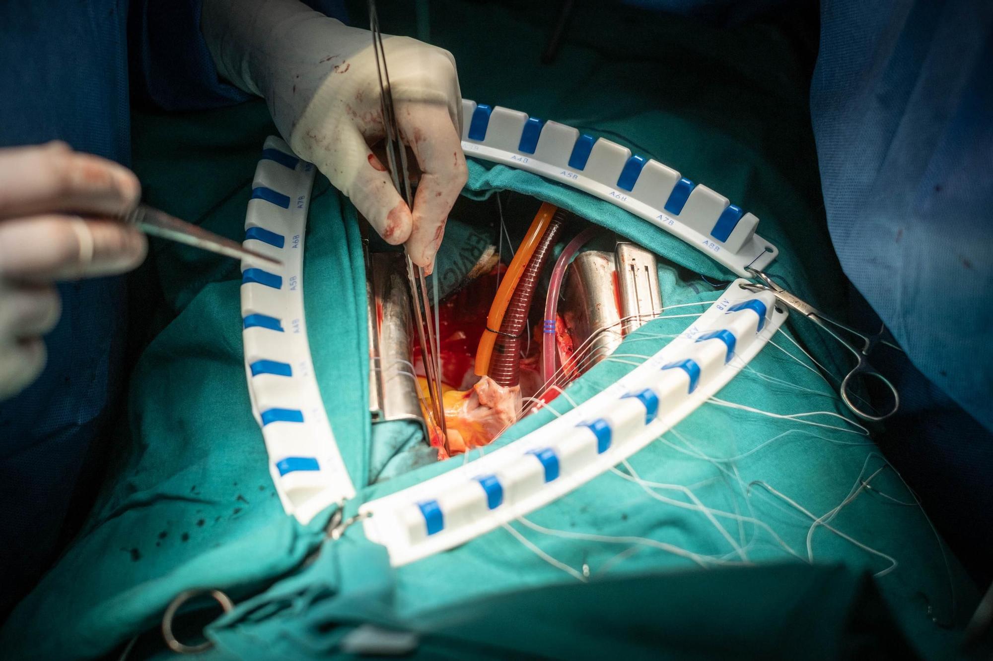 Realización de una cirugía extracorpórea enel HUC