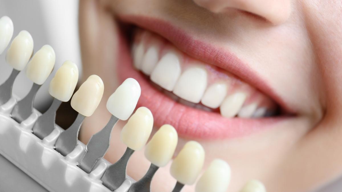 Blanqueamiento dental: carillas dentales minimamente invasivas