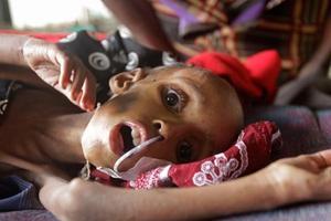 Un nen malalt per desnutrició, en un hospital de Metges sense Fronteres a Dadaab, Kenya.