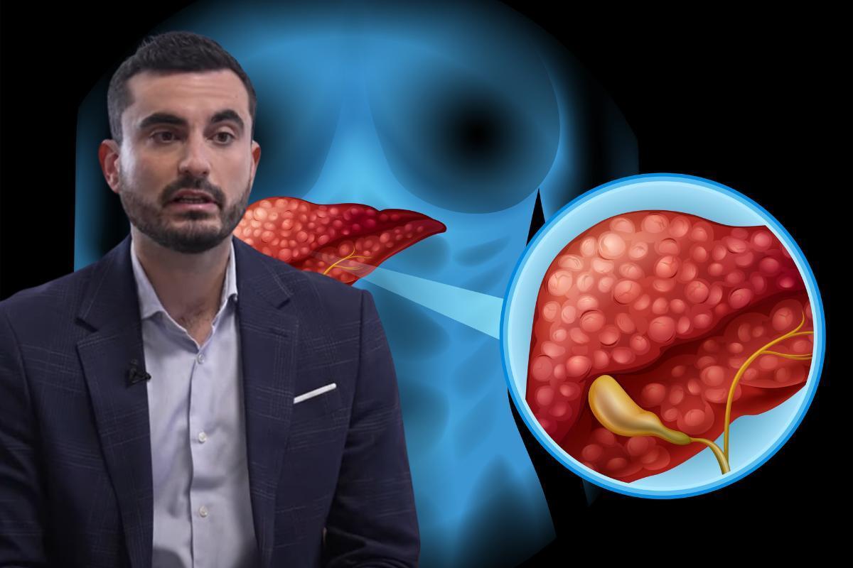 El cáncer de hígado puede no dar síntomas: una simple ecografía cada 6 meses puede salvar tu vida