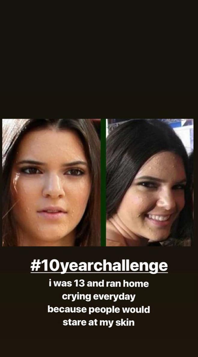 Kendall Jenner y sus problemas de acné hace 10 años