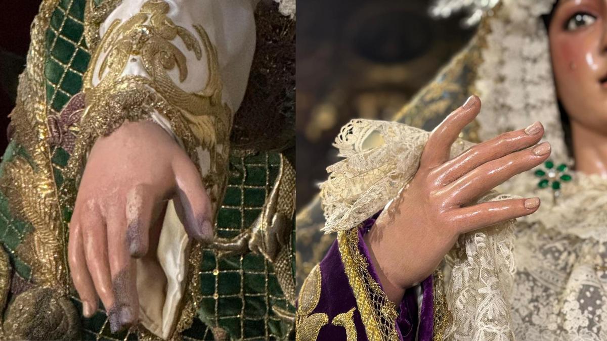 A la izquierda, se muestra las manos de la Macarena en diciembre, mientras en lado derecho aparece su estado actual tras la última intervención.