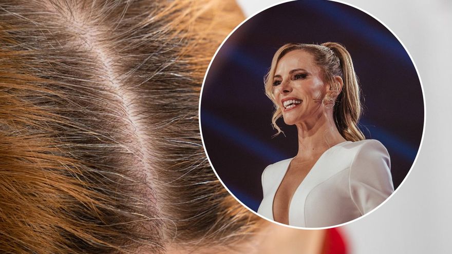 Qué es la alopecia areata: el trastorno autoinmune que padeció Paula Vázquez y que puede afectar a la salud mental