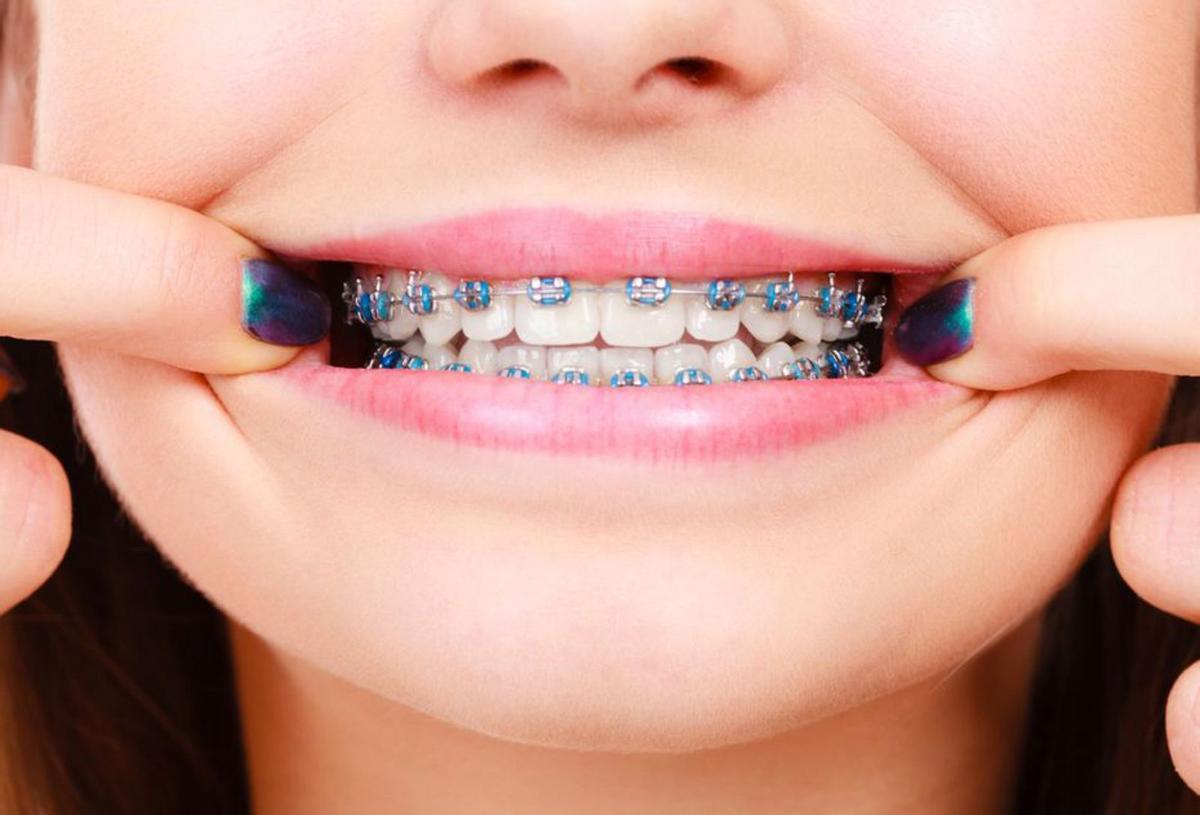 Los ‘brackets’ se suelen empezar a usar en la adolescencia. |