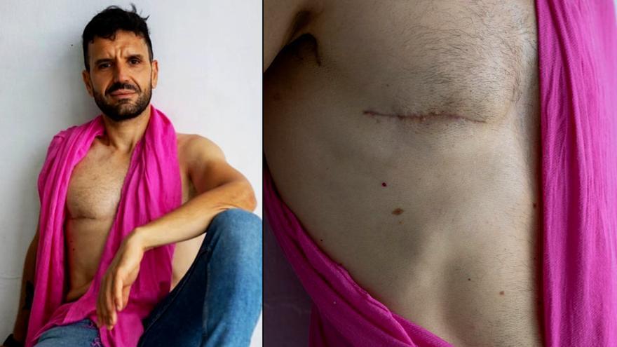 Mikel Reyes, Paciente de cáncer de mama: "Una mujer preguntó qué hacía yo en la sala de espera de una mamografía"