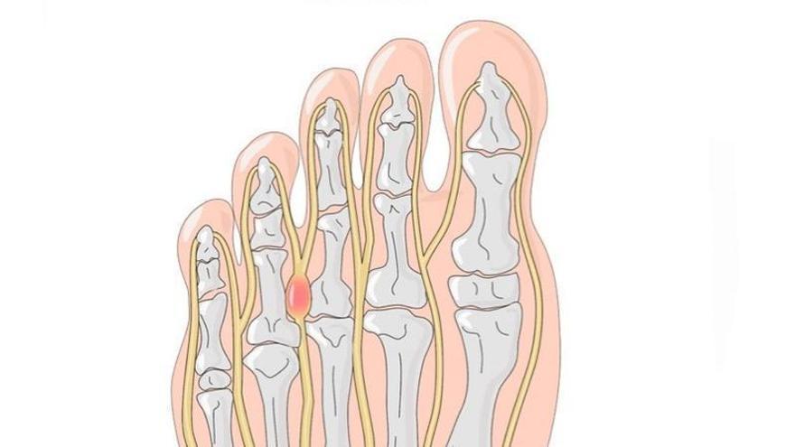 El neuroma de Morton