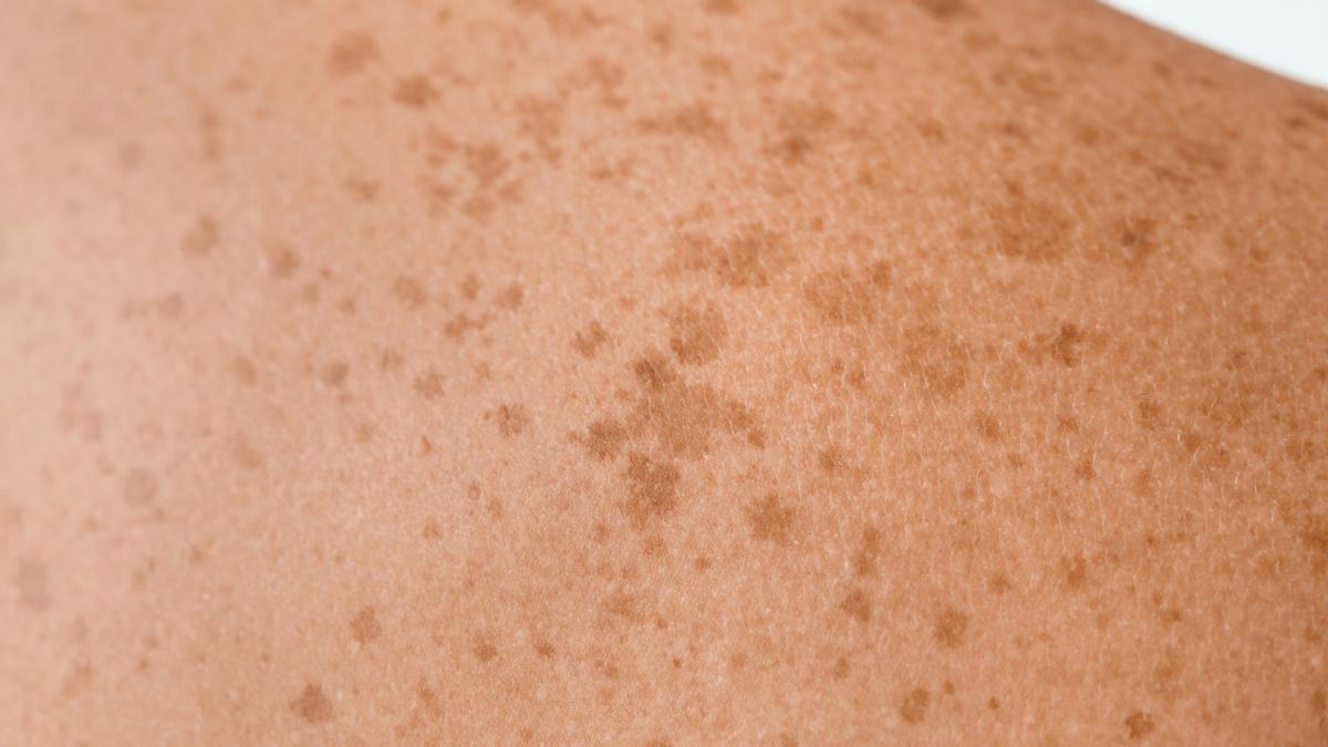 Skin with spots as a result of excessive sun exposure.