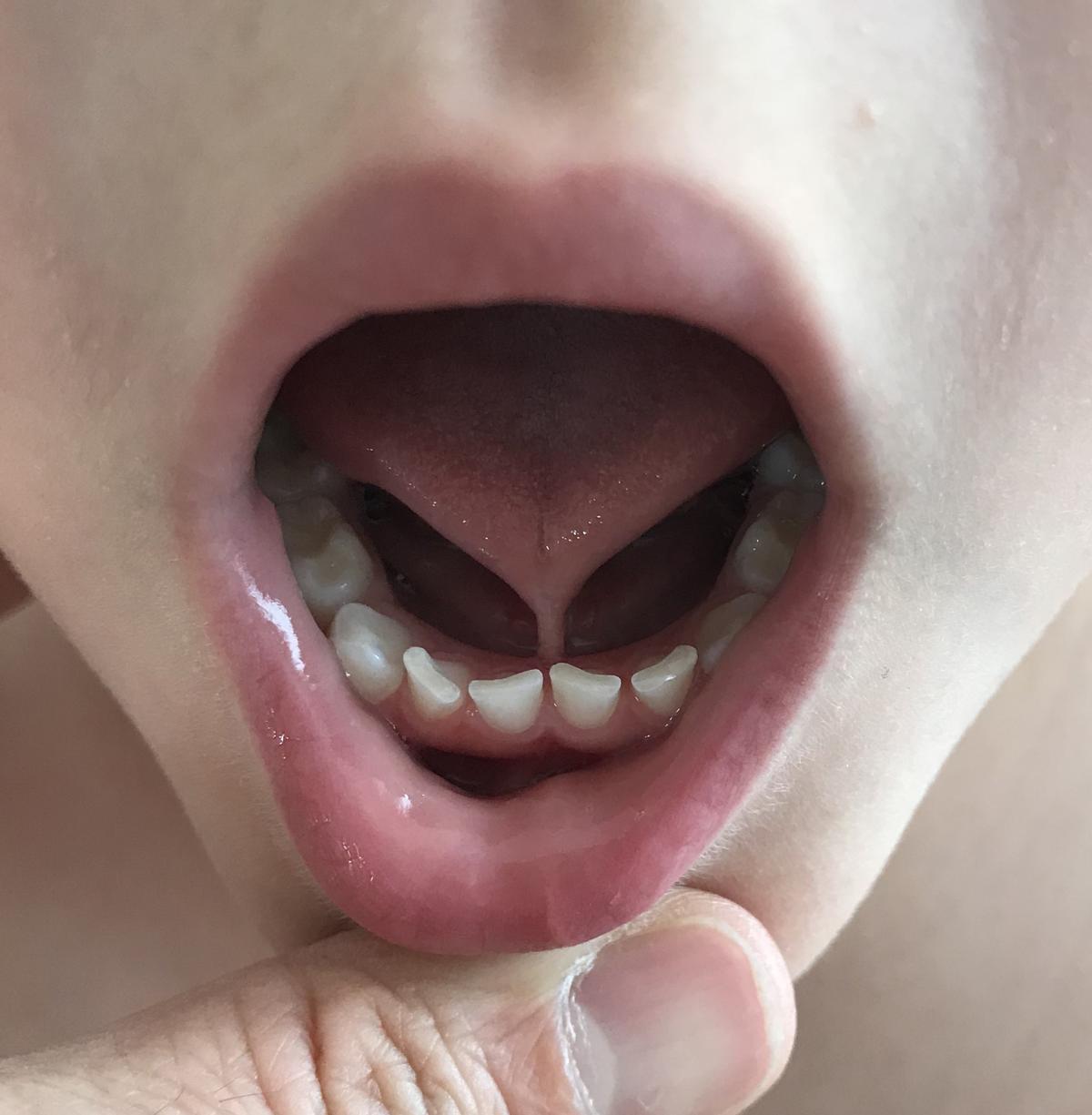 Anquiloglosia (lengua trabada) por frenillo lingual corto, en un niño de 4 años.