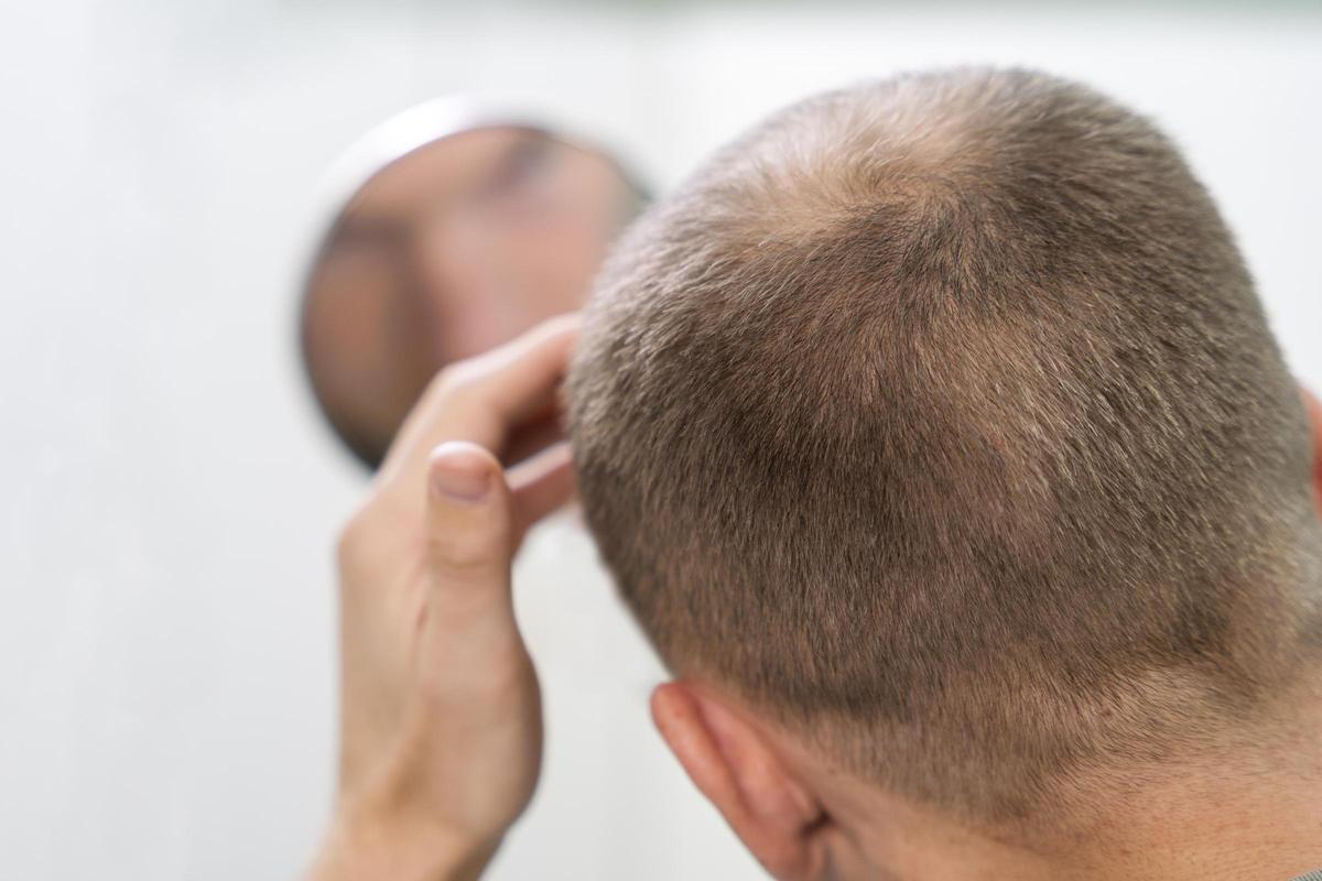 Las canas sumadas a la alopecia suelen despertar inseguridades.