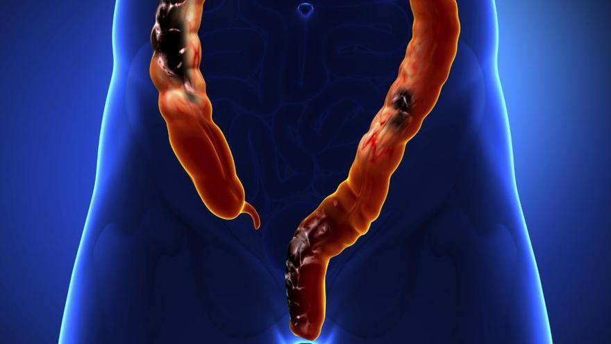 Ramucirumab alarga la vida de los afectados por el cáncer de colon.