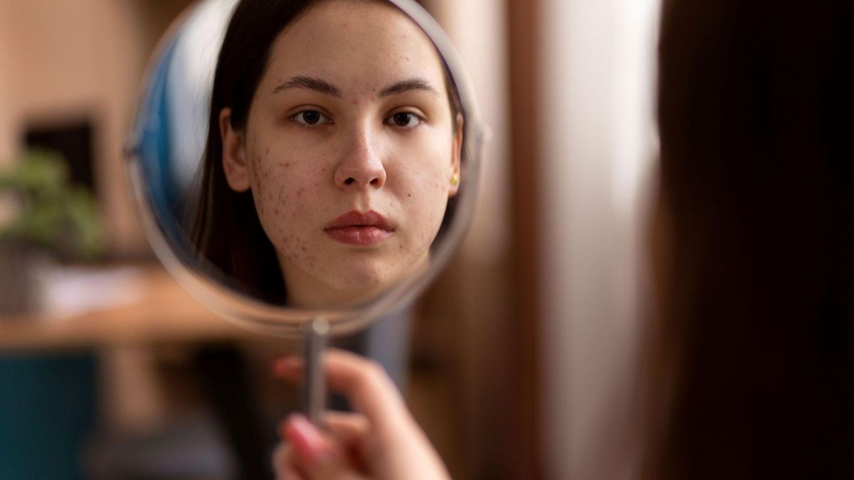 El acné suele estar asociado con la adolescencia y los cambios hormonales que se producen durante esta etapa, pero también puede aparecer fuera de ella.