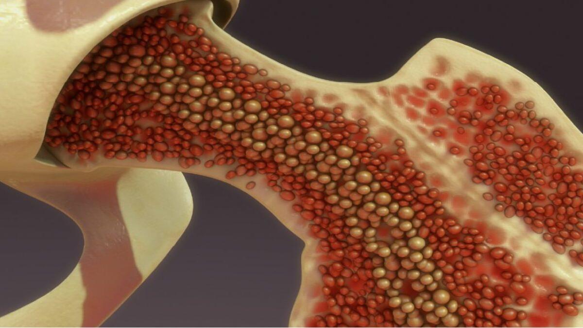 El origen de ictus e infarto está en la médula ósea