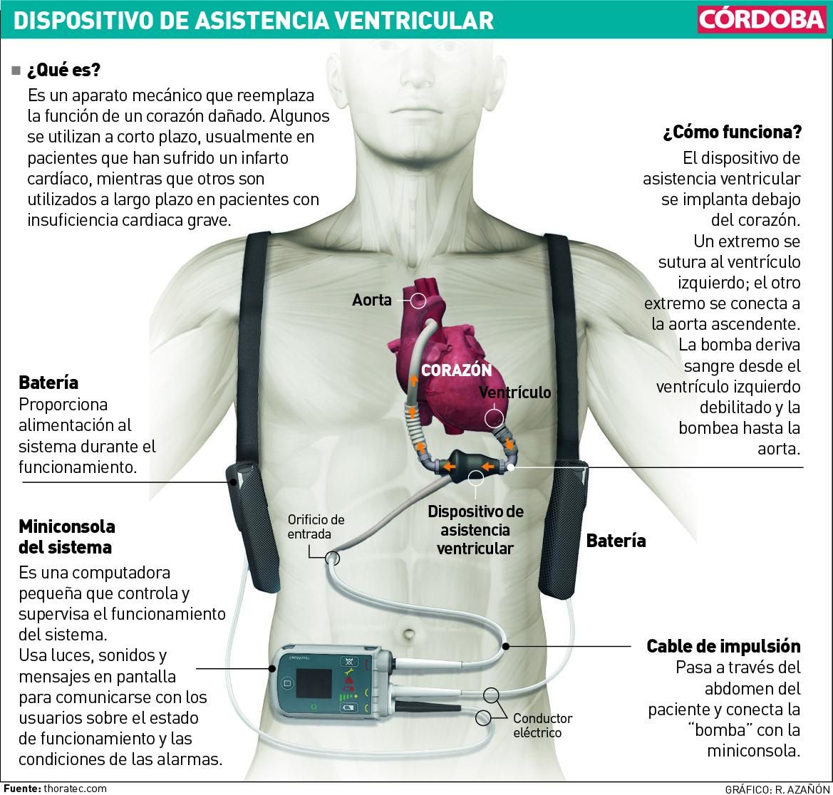 Dispositivo de asistencia ventricular.