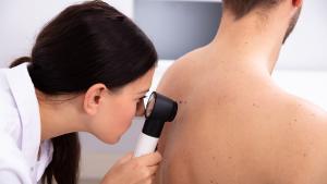 Entre el 2% y el 10% de los supervivientes de un melanoma desarrollarán un segundo melanoma primario.