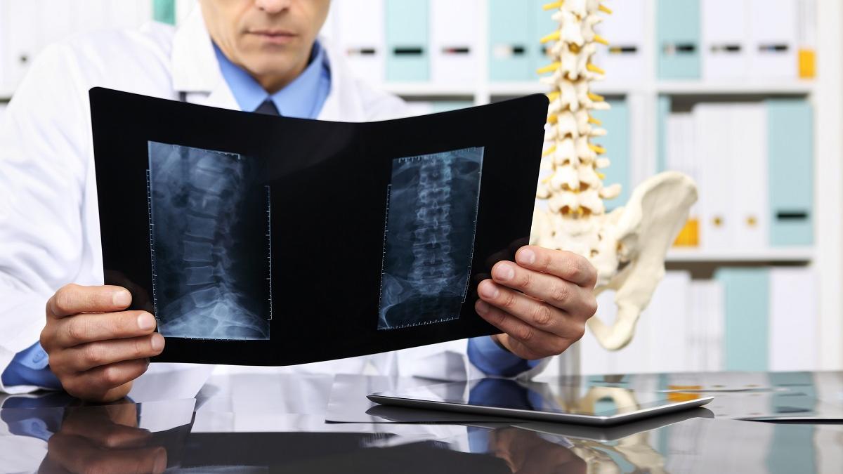 La estenosis del canal lumbar está detrás de muchos dolores de espalda.