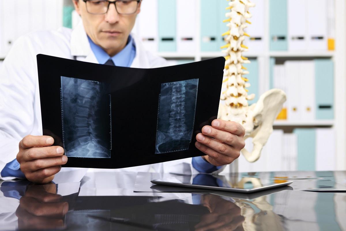 La estenosis del canal lumbar está detrás de muchos dolores de espalda.