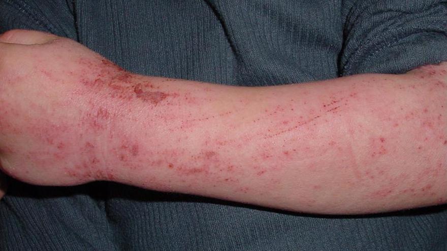 Las huellas que van unidas a la dermatitis atópica son muy expresivas.