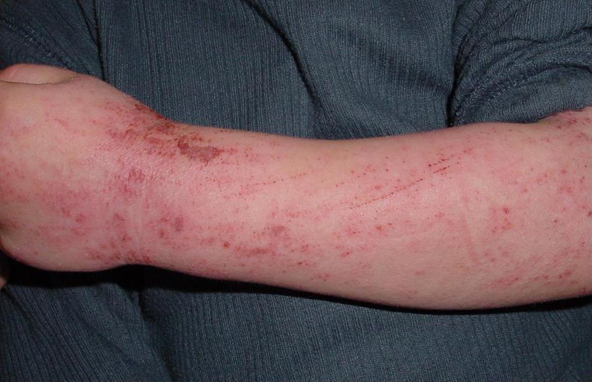 Las huellas que van unidas a la dermatitis atópica son muy expresivas.