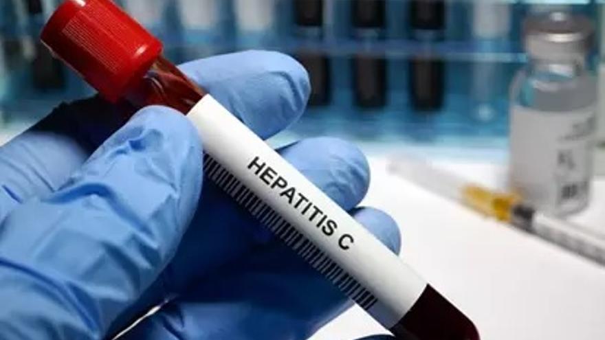 Una muestra positiva en el virus de la hepatitis C.