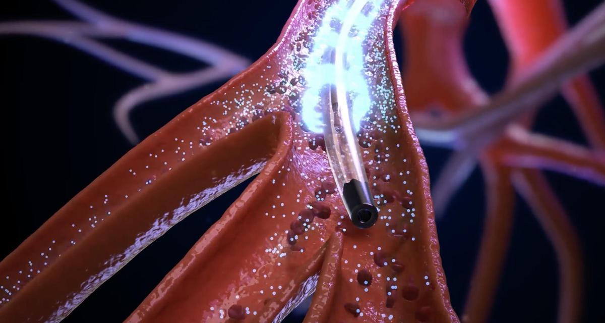 Tromboembolismo Pulmonar