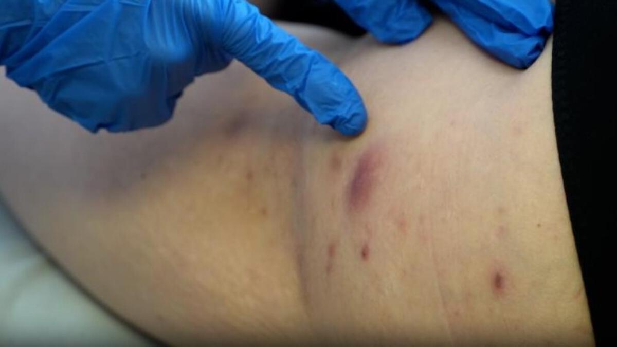La hidradenitis supurativa tarda en diagnosticarse hasta 10 años