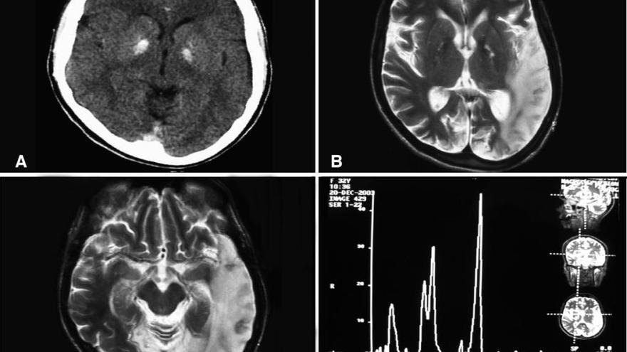 Hallan nuevas terapias contra los tumores cerebrales