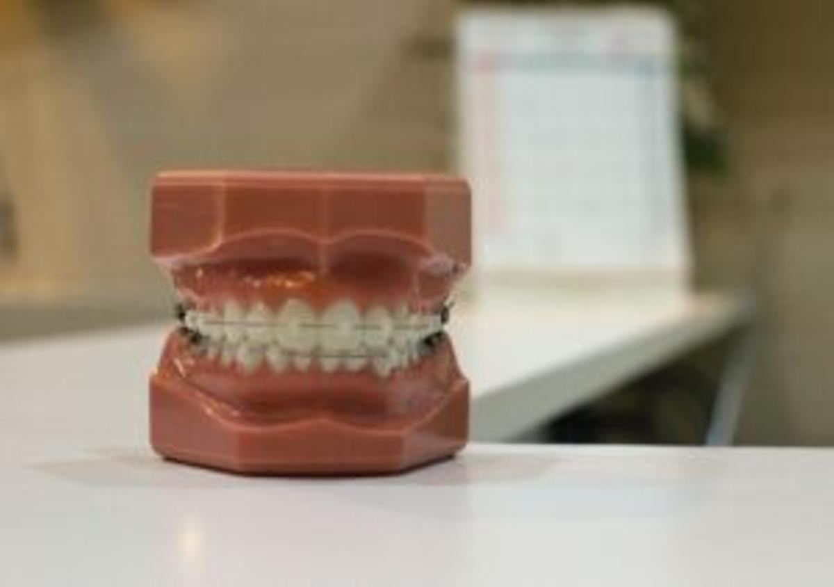 Brackets falsos, la nueva moda que pone en riesgo nuestra salud