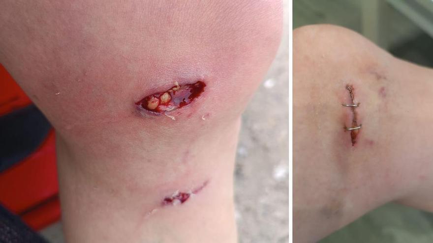 Una vecina de Vigo denuncia el ataque de un perro sin correa