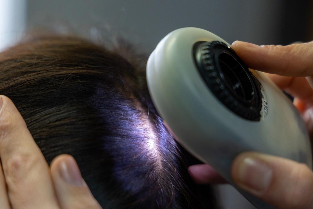 Una de cada cuatro jóvenes sufre excesiva caída del cabello y los peinados tirantes son una de las causas n Una de cada cuatro jóvenes sufre excesiva caída del cabello y los peinados tirantes son una de las causas n