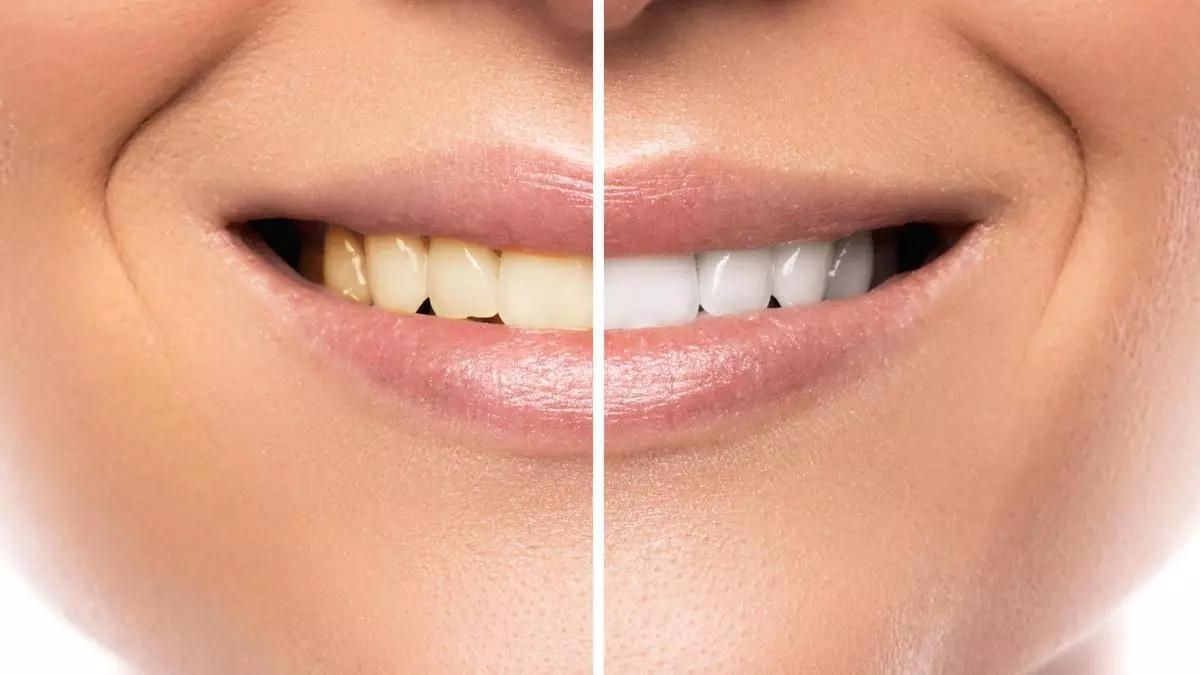 En Clínicas Udemax podrás someterete a tratamiento de blanquamiento y ortodoncia invisible para recuperar tu sonrisa ideal en menos tiempo.