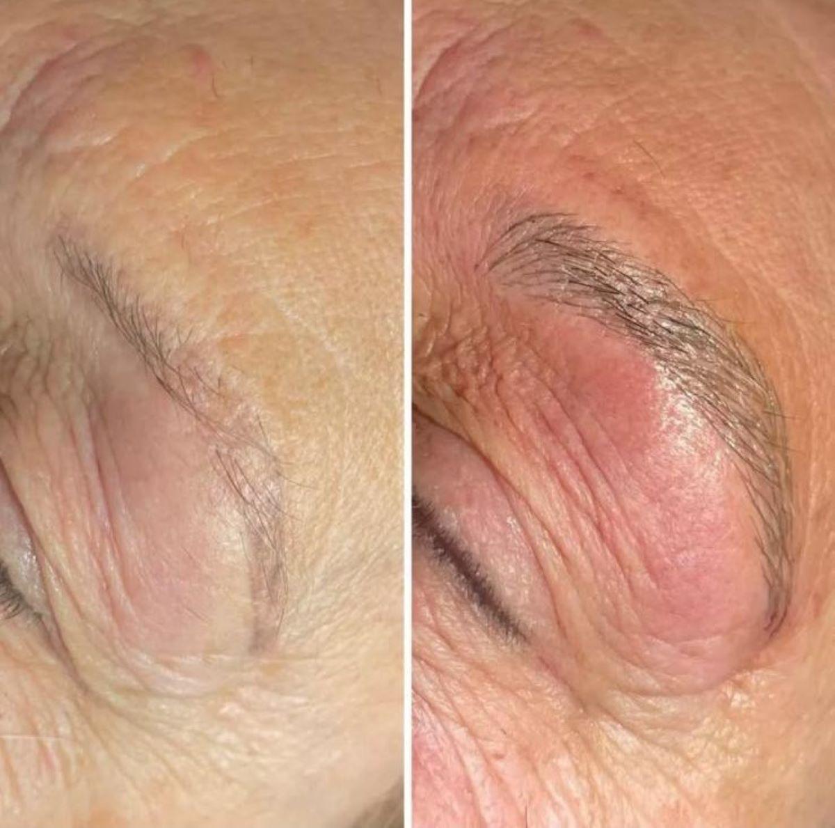 A la izquierda, una ceja poco poblada de pelo y casi sin presencia en el rostro antes de utilizar la técnica del microblading. A la derecha, la misma ceja una vez aplicada la pigmentación del microblading.