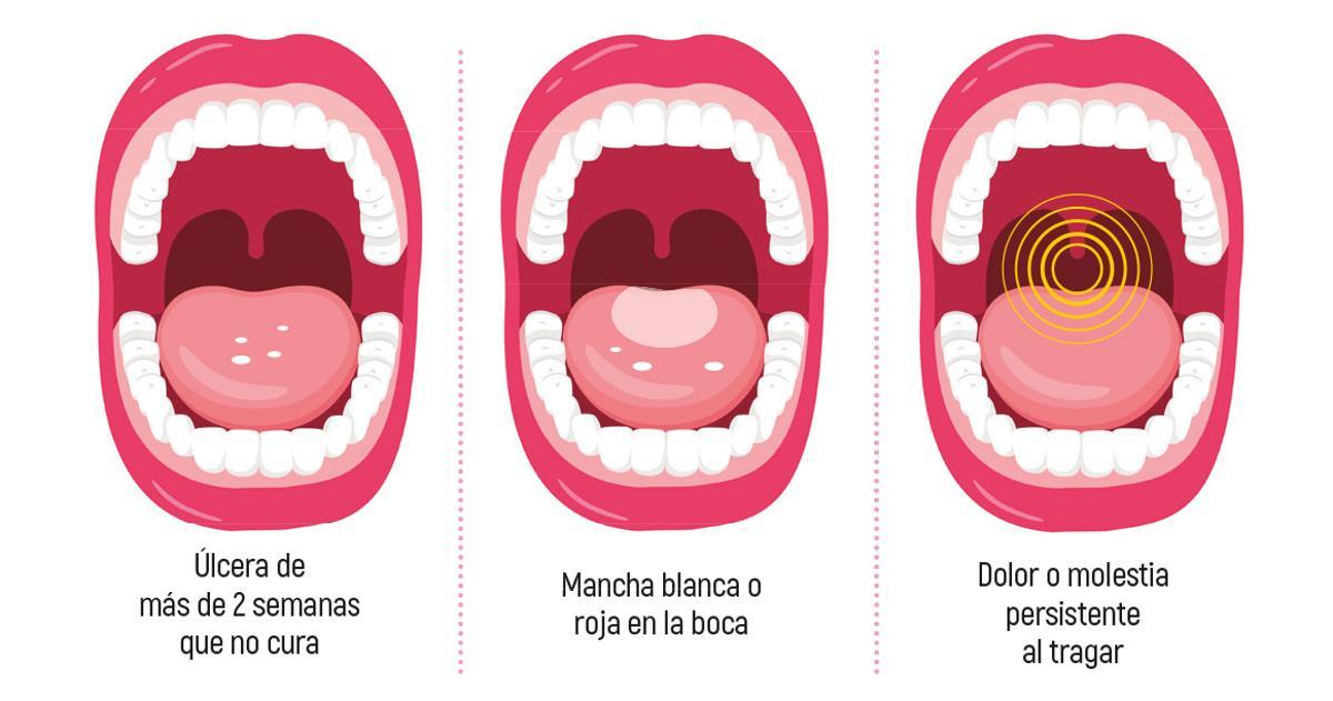 El cáncer oral se sitúa entre los 10 cánceres más comunes, pero reduciendo el consumo de tabaco y alcohol se puede prevenir.