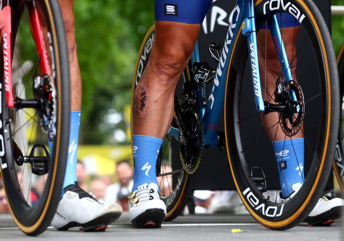 Dax (France), 04/07/2023.- The bruised calf of Slovak rider Peter Sagan of team TotalEnergies before the start of the 4th stage of the Tour de France 2023, a 181,8km race from Dax to Nogaro, Dax, France, 04 July 2023. (Ciclismo, Francia) EFE/EPA/MARTIN DIVISEK