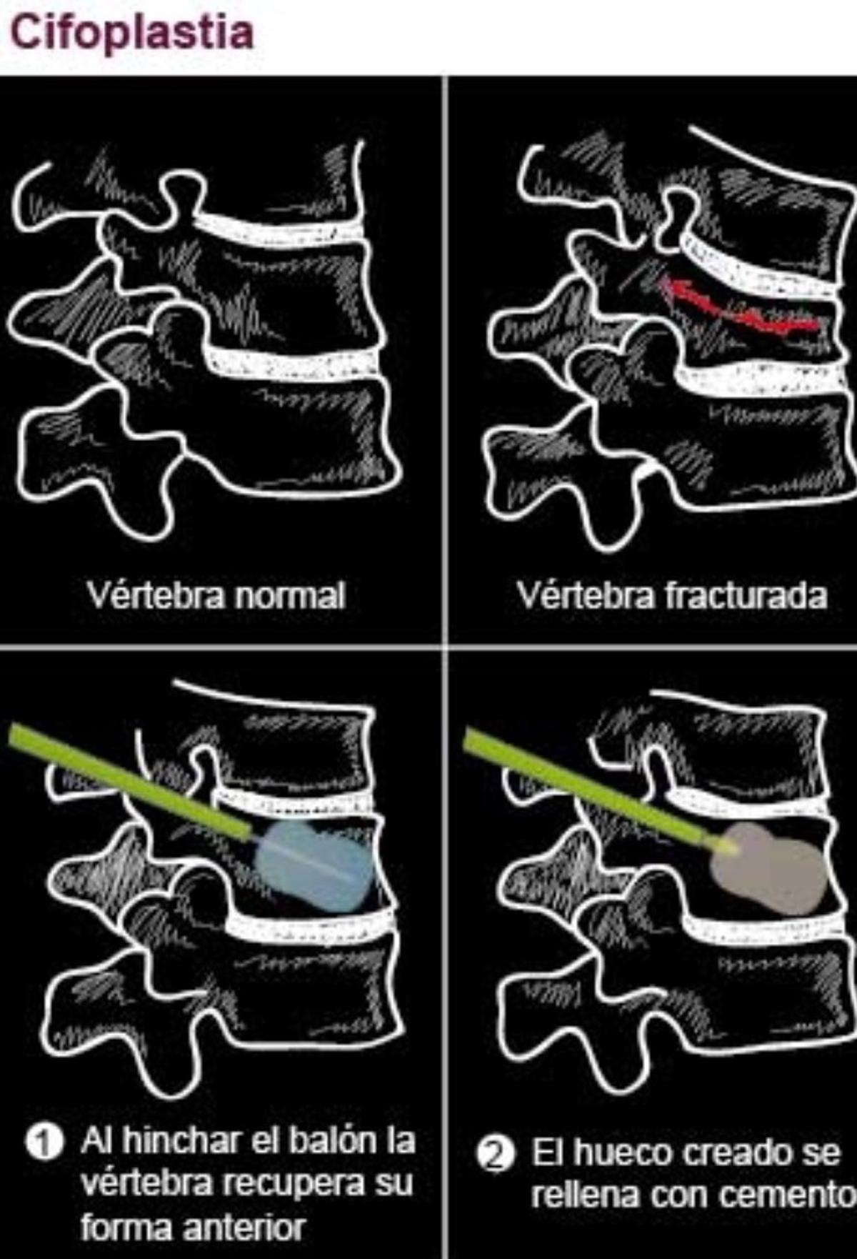 Cifoplastia.