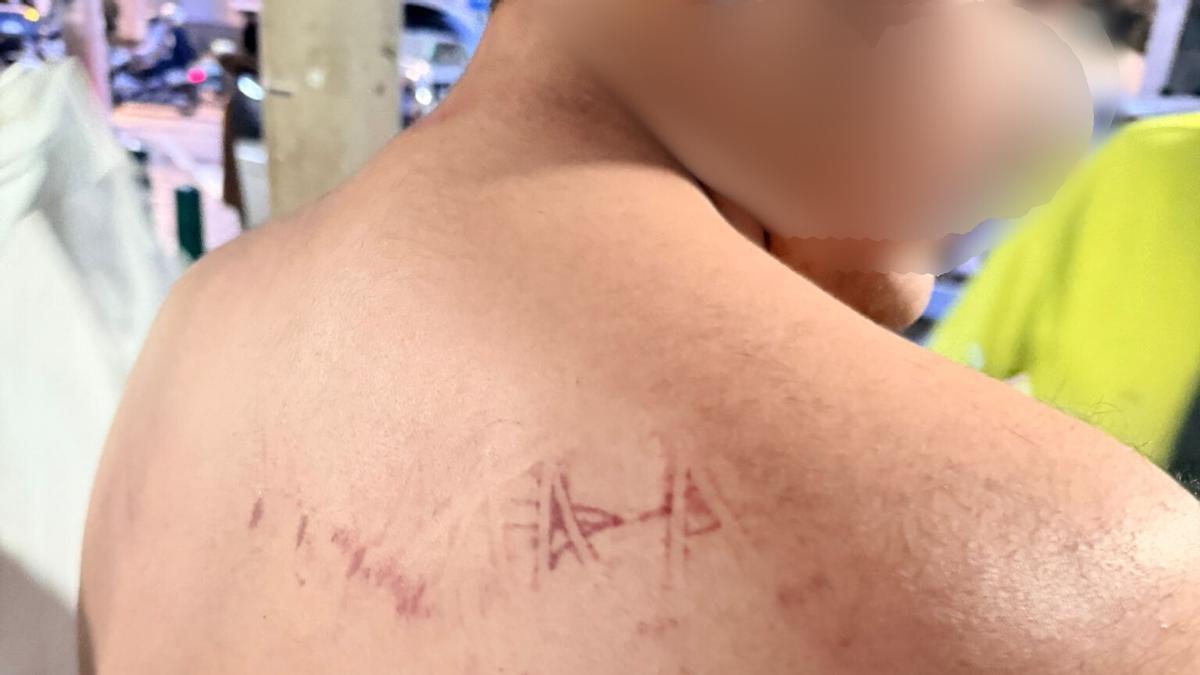 Una de las fotografias de las lesiones del menor presentadas ante el juzgado tras el motín en Juslibol.