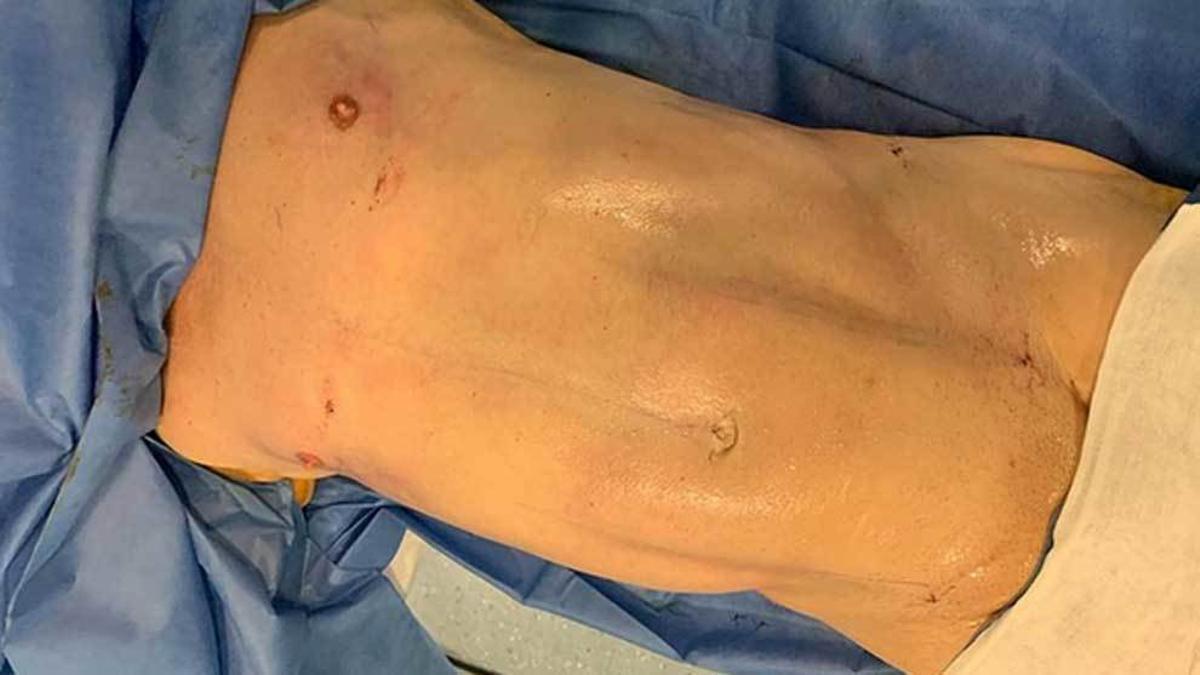Operación de abdomen de Pipi Estrada