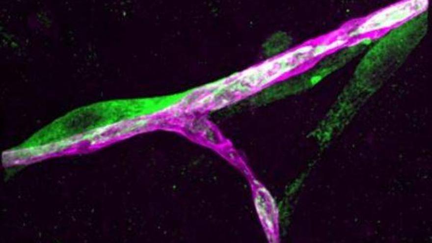 Massagué descubre una de las claves de la metástasis del cáncer cerebral