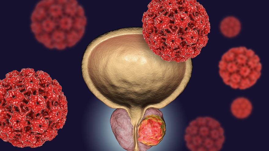 Síntomas, diagnóstico y cirugía robótica: así se aborda hoy el cáncer de próstata
