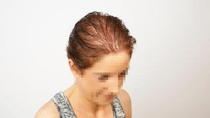 Una de las patologías que tratan es la alopecia post menopaúsica.