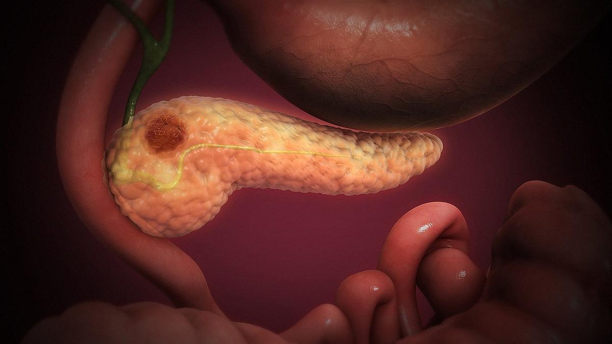 Cancer de pancreas: imágenes de células cancerosas formando un bulto en el tejido pancreático.