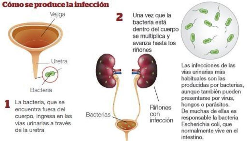 Cistitis o infección urinaria, cómo prevenirla