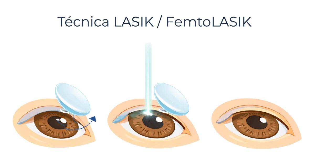 Técnica LASIK y FemtoLASIK.
