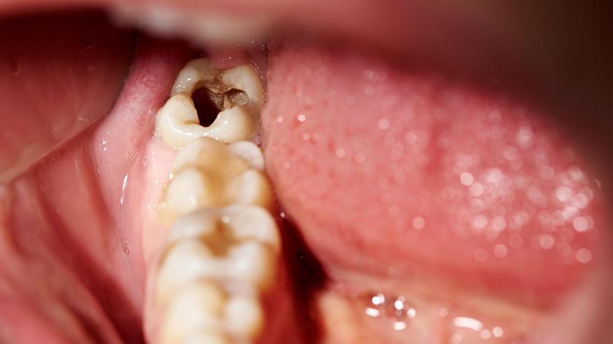 Les obturacions dentals: els seus diferents tipus i importància