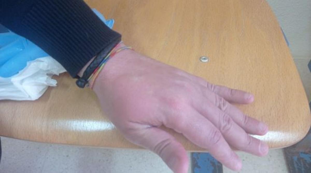 Imagen de la mano del funcionario herido, completamente hinchada por los golpes.