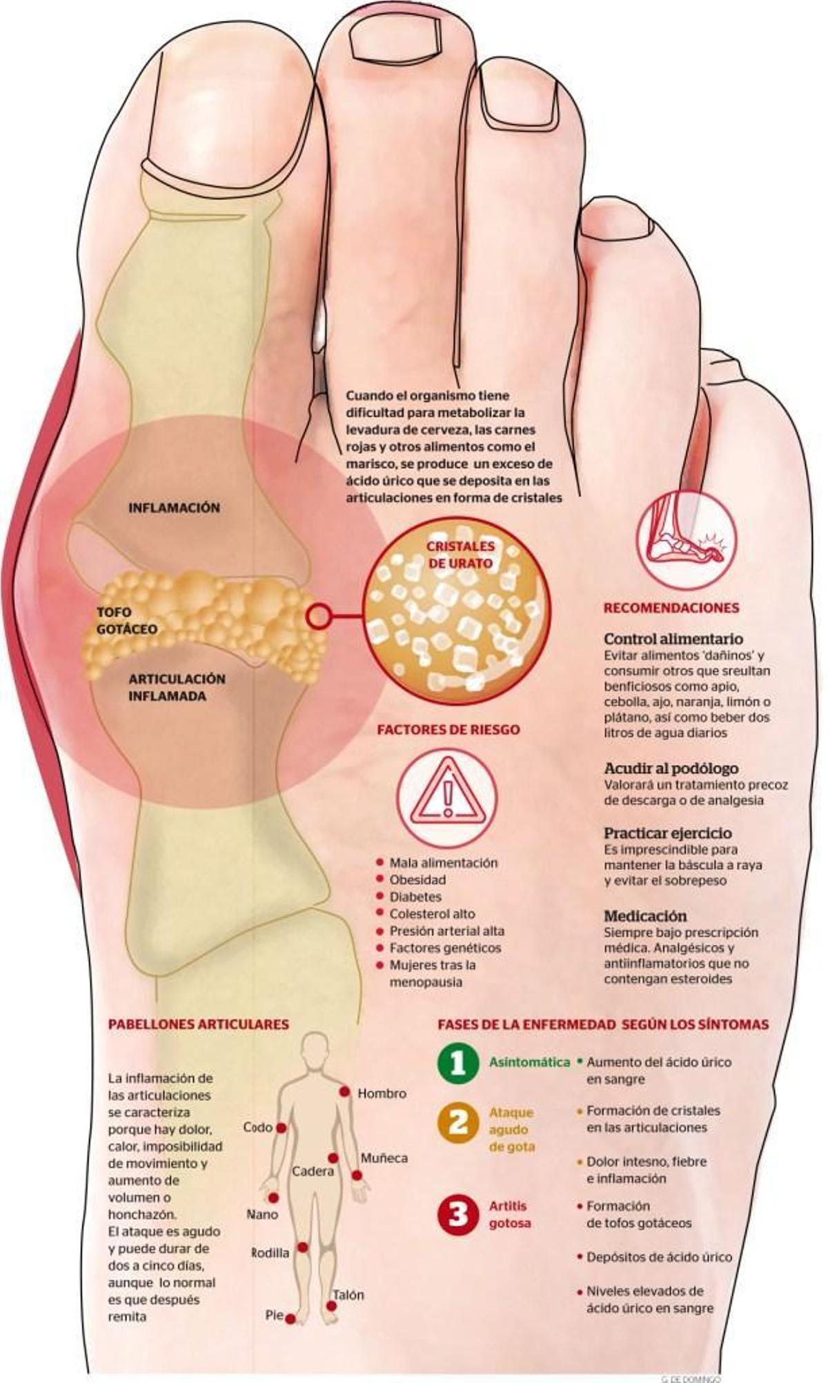 La gota, enfermedad de reyes