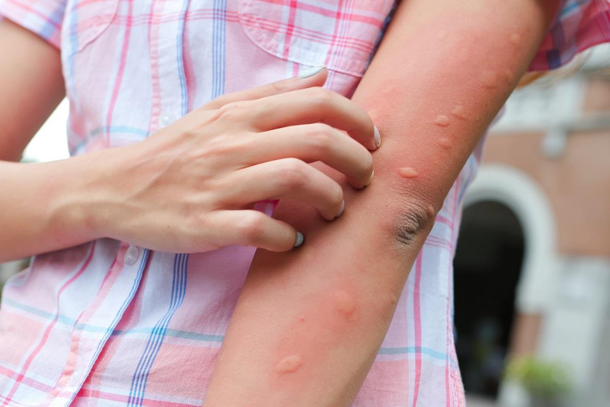 Las picaduras del mosquito tigre son más molestas y puede provocar reacciones alérgicas.
