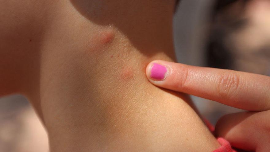 Picaduras de mosquitos en un niño.
